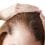 Frontale fibroserende alopecia bij vrouwen
